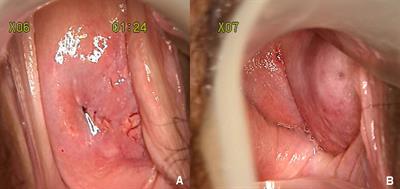 Case Report: A rare case of gastric-type adenocarcinoma of stumps of duplicated cervices in a 49-year-old woman: A case with hidden focus confused us a lot
